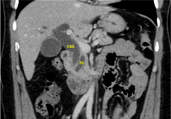 CT scan showing dilated bile duct and pancreatic duct
